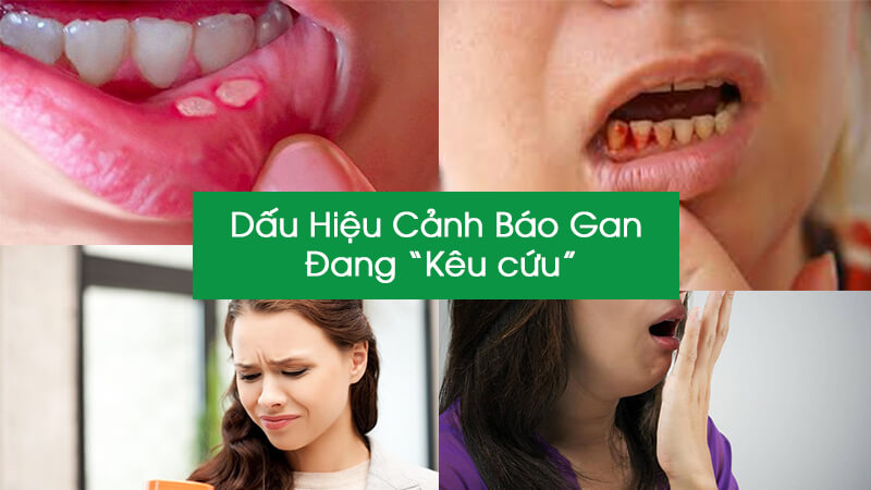 4 dấu hiệu trên miệng cảnh báo gan đang 