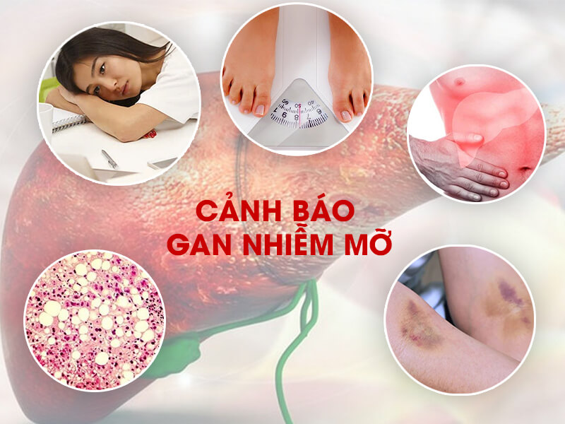 5 dấu hiệu cảnh báo gan nhiễm mỡ thường bị bỏ qua