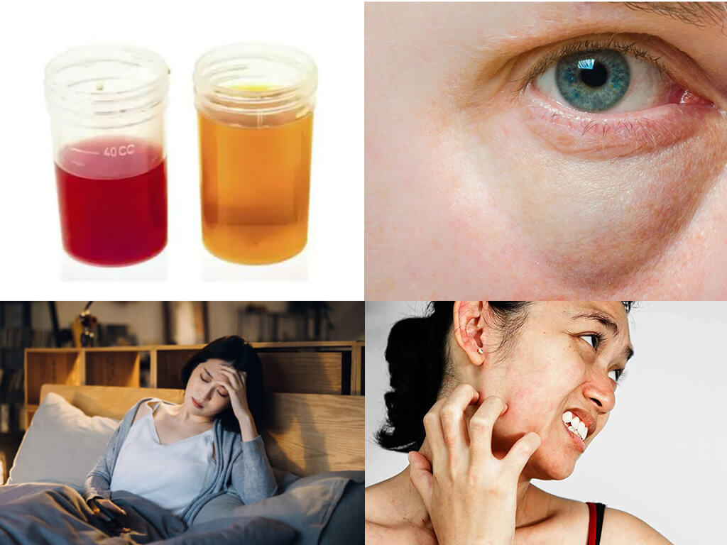 Đừng bỏ qua: Những dấu hiệu âm thầm cảnh báo thận đang gặp vấn đề!