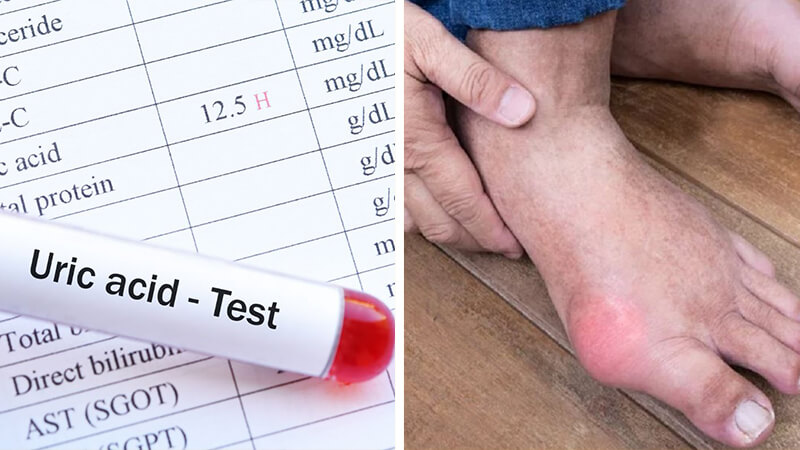 Cách đào thải axit uric ra khỏi cơ thể nhanh nhất