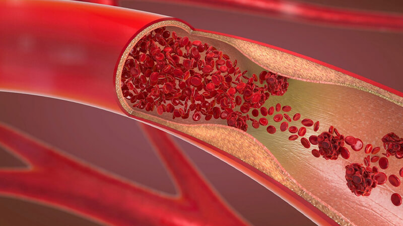 5 dấu hiệu bất thường ở tay, chân cảnh báo cục máu đông 