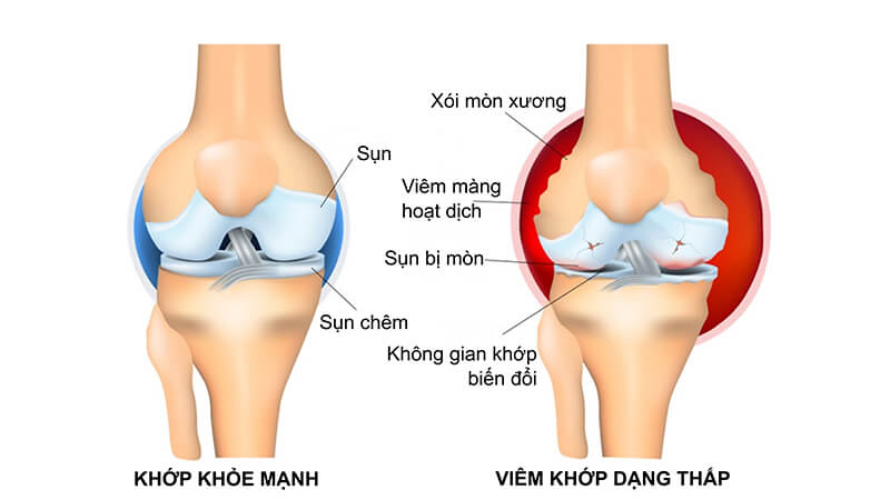 Điều gì xảy ra nếu khớp không khỏe mạnh? Nguy Cơ Và Giải Pháp