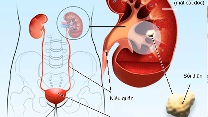 Ăn gì để phòng ngừa sỏi thận hiệu quả?